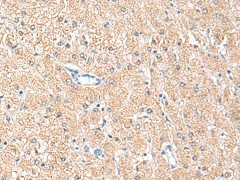 Immunohistochemistry of paraffin-embedded Human liver cancer tissue using MLKL Polyclonal Antibody at dilution of 1:85(×200)