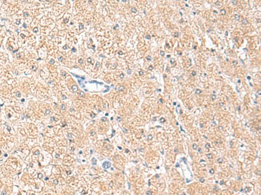 Immunohistochemistry of paraffin-embedded Human liver cancer tissue using MLKL Polyclonal Antibody at dilution of 1:85(×200)