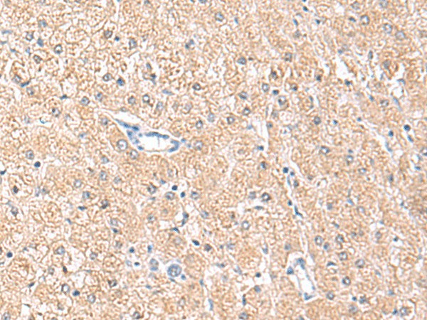 Immunohistochemistry of paraffin-embedded Human liver cancer tissue using MLKL Polyclonal Antibody at dilution of 1:85(×200)
