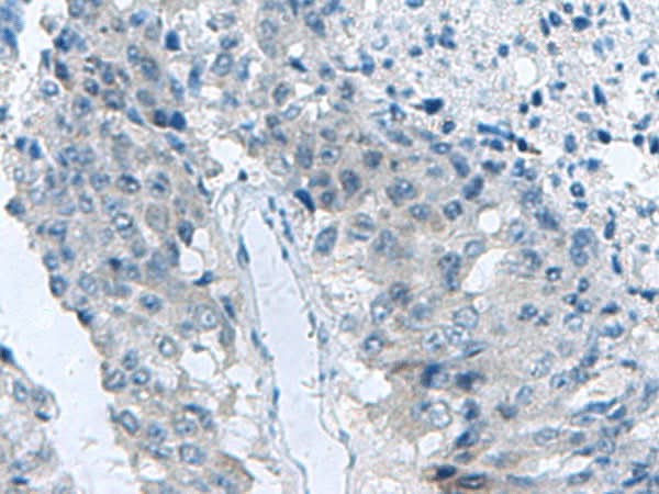 Immunohistochemistry of paraffin-embedded Human liver cancer tissue using MED31 Polyclonal Antibody at dilution of 1:140(×200)