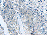 Immunohistochemistry of paraffin-embedded Human liver cancer tissue using MED31 Polyclonal Antibody at dilution of 1:140(×200)