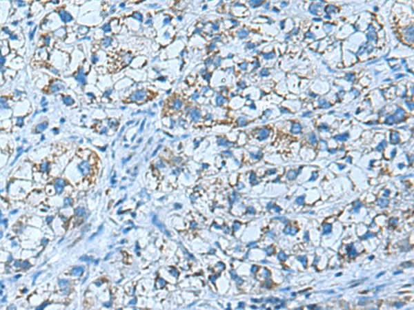 Immunohistochemistry of paraffin-embedded Human liver cancer tissue using GUCA1A Polyclonal Antibody at dilution of 1:50(×200)