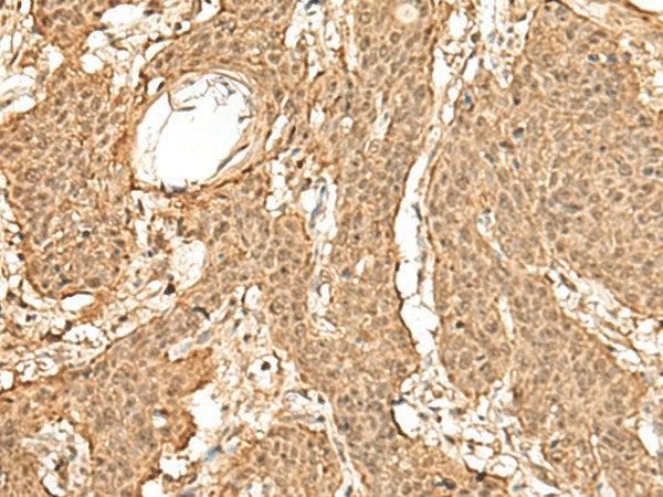 Immunohistochemistry of paraffin-embedded Human esophagus cancer tissue using TIPRL Polyclonal Antibody at dilution of 1:60(×200)