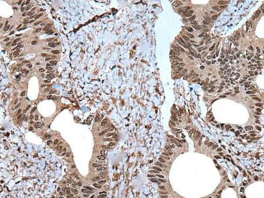 Immunohistochemistry of paraffin-embedded Human colorectal cancer tissue using ZNF787 Polyclonal Antibody at dilution of 1:45(×200)