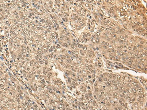 Immunohistochemistry of paraffin-embedded Human liver cancer tissue using BRF2 Polyclonal Antibody at dilution of 1:40(×200)