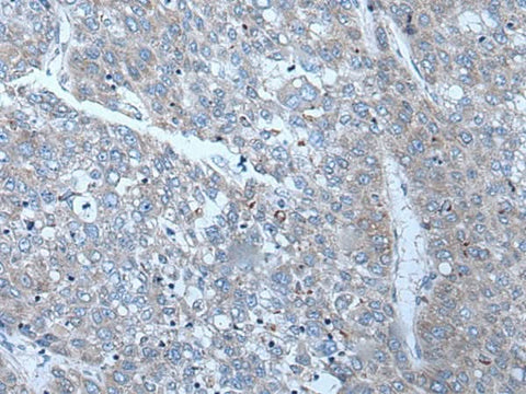 Immunohistochemistry of paraffin-embedded Human liver cancer tissue using SLC24A5 Polyclonal Antibody at dilution of 1:50(×200)