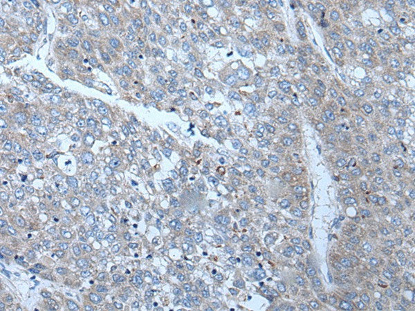 Immunohistochemistry of paraffin-embedded Human liver cancer tissue using SLC24A5 Polyclonal Antibody at dilution of 1:50(×200)