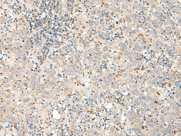 Immunohistochemistry of paraffin-embedded Human cervical cancer tissue using GALR1 Polyclonal Antibody at dilution of 1:60(×200)