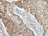 Immunohistochemistry of paraffin-embedded Human lung cancer tissue using BBS12 Polyclonal Antibody at dilution of 1:50(×200)