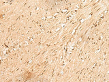 Immunohistochemistry of paraffin-embedded Human colorectal cancer tissue using JPT2 Polyclonal Antibody at dilution of 1:80(×200)