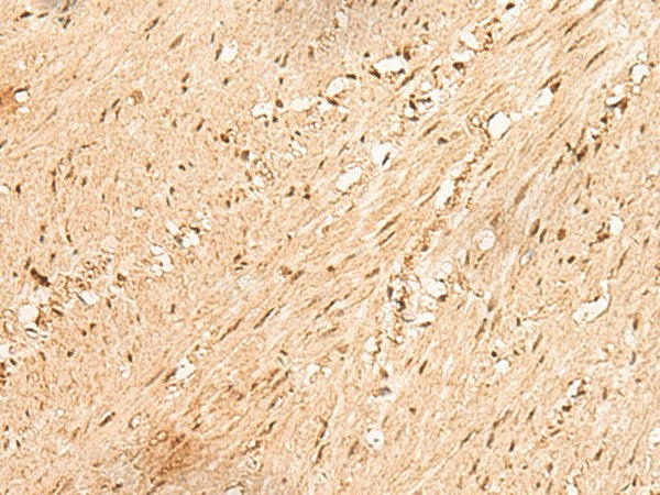 Immunohistochemistry of paraffin-embedded Human colorectal cancer tissue using JPT2 Polyclonal Antibody at dilution of 1:80(×200)
