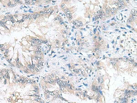 Immunohistochemistry of paraffin-embedded Human lung cancer tissue using CAMSAP3 Polyclonal Antibody at dilution of 1:90(×200)