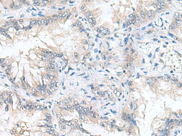 Immunohistochemistry of paraffin-embedded Human lung cancer tissue using CAMSAP3 Polyclonal Antibody at dilution of 1:90(×200)