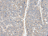 Immunohistochemistry of paraffin-embedded Human liver cancer tissue using THAP10 Polyclonal Antibody at dilution of 1:40(×200)