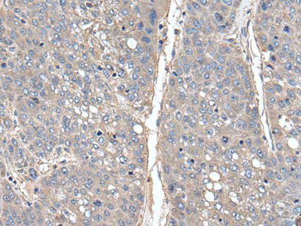 Immunohistochemistry of paraffin-embedded Human liver cancer tissue using THAP10 Polyclonal Antibody at dilution of 1:40(×200)