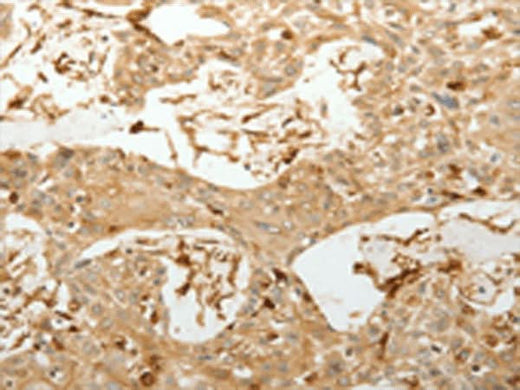 Immunohistochemistry of paraffin-embedded Human esophagus cancer tissue using VMA21 Polyclonal Antibody at dilution of 1:150(×200)