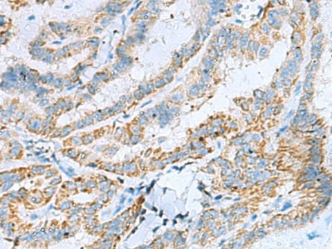 Immunohistochemistry of paraffin-embedded Human thyroid cancer tissue using KIF5A Polyclonal Antibody at dilution of 1:30(×200)