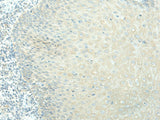 Immunohistochemistry of paraffin-embedded Human esophagus cancer tissue using EVI2B Polyclonal Antibody at dilution of 1:40(×200)