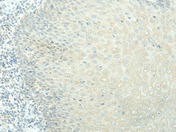Immunohistochemistry of paraffin-embedded Human esophagus cancer tissue using EVI2B Polyclonal Antibody at dilution of 1:40(×200)