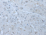 Immunohistochemistry of paraffin-embedded Human esophagus cancer tissue using HUWE1 Polyclonal Antibody at dilution of 1:30(×200)