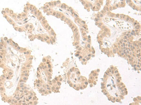 Immunohistochemistry of paraffin-embedded Human thyroid cancer tissue using PBXIP1 Polyclonal Antibody at dilution of 1:40(×200)