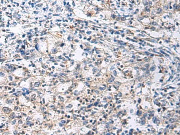 Immunohistochemistry of paraffin-embedded Human gastric cancer tissue using SLC30A3 Polyclonal Antibody at dilution of 1:70(×200)
