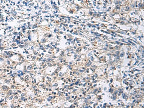Immunohistochemistry of paraffin-embedded Human gastric cancer tissue using SLC30A3 Polyclonal Antibody at dilution of 1:70(×200)