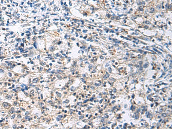 Immunohistochemistry of paraffin-embedded Human gastric cancer tissue using SLC30A3 Polyclonal Antibody at dilution of 1:70(×200)