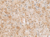 Immunohistochemistry of paraffin-embedded Human liver cancer tissue using RTKN2 Polyclonal Antibody at dilution of 1:70(×200)