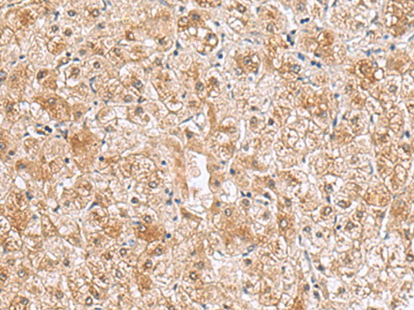 Immunohistochemistry of paraffin-embedded Human liver cancer tissue using RTKN2 Polyclonal Antibody at dilution of 1:70(×200)