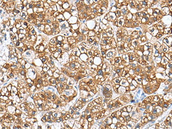 Immunohistochemistry of paraffin-embedded Human liver cancer tissue using PHLDA3 Polyclonal Antibody at dilution of 1:110(×200)