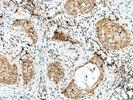 Immunohistochemistry of paraffin-embedded Human esophagus cancer tissue using RBM15 Polyclonal Antibody at dilution of 1:50(×200)