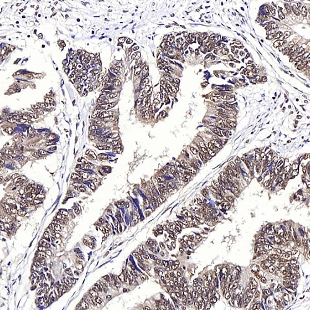 Immunohistochemistry analysis of paraffin-embedded human colon cancer using JMJD6 Polyclonal Antibody at dilution of 1:1000.