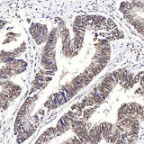 Immunohistochemistry analysis of paraffin-embedded human colon cancer using JMJD6 Polyclonal Antibody at dilution of 1:1000.