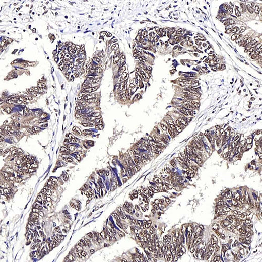 Immunohistochemistry analysis of paraffin-embedded human colon cancer using JMJD6 Polyclonal Antibody at dilution of 1:1000.