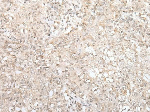 Immunohistochemistry of paraffin-embedded Human esophagus cancer tissue using ZNF263 Polyclonal Antibody at dilution of 1:40(×200)