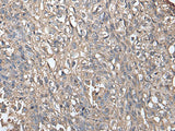 Immunohistochemistry of paraffin-embedded Human lung cancer tissue using NDUFB5 Polyclonal Antibody at dilution of 1:45(×200)