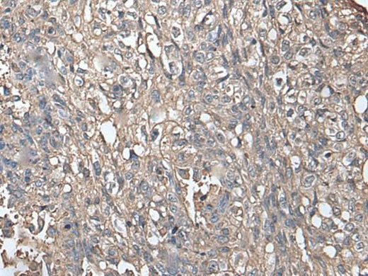 Immunohistochemistry of paraffin-embedded Human lung cancer tissue using NDUFB5 Polyclonal Antibody at dilution of 1:45(×200)