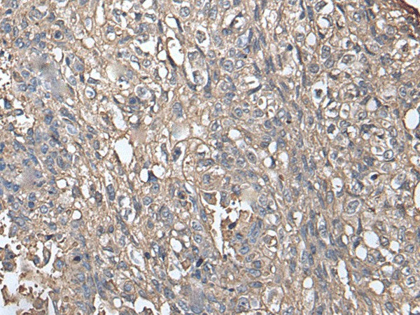 Immunohistochemistry of paraffin-embedded Human lung cancer tissue using NDUFB5 Polyclonal Antibody at dilution of 1:45(×200)