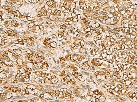 Immunohistochemistry of paraffin-embedded Human liver cancer tissue using MTAP Polyclonal Antibody at dilution of 1:70(×200)