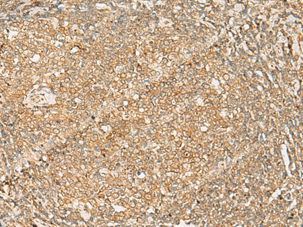 Immunohistochemistry of paraffin-embedded Human tonsil tissue using FNTB Polyclonal Antibody at dilution of 1:35(×200)