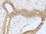 Immunohistochemistry of paraffin-embedded Human breast cancer tissue using NABP1 Polyclonal Antibody at dilution of 1:50(×200)