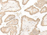 Immunohistochemistry of paraffin-embedded Human thyroid cancer tissue using DCD Polyclonal Antibody at dilution of 1:35(×200)