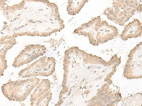 Immunohistochemistry of paraffin-embedded Human thyroid cancer tissue using DCD Polyclonal Antibody at dilution of 1:35(×200)