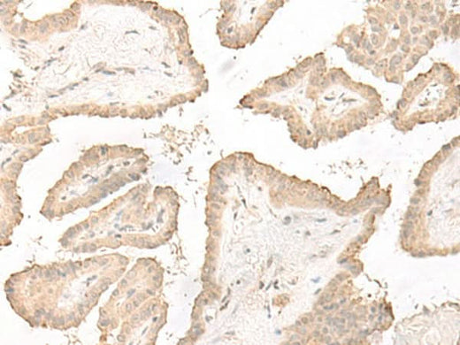 Immunohistochemistry of paraffin-embedded Human thyroid cancer tissue using DCD Polyclonal Antibody at dilution of 1:35(×200)