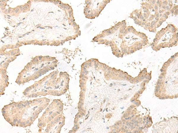 Immunohistochemistry of paraffin-embedded Human thyroid cancer tissue using DCD Polyclonal Antibody at dilution of 1:35(×200)