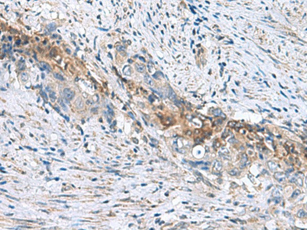 Immunohistochemistry of paraffin-embedded Human cervical cancer tissue using RNF208 Polyclonal Antibody at dilution of 1:55(×200)
