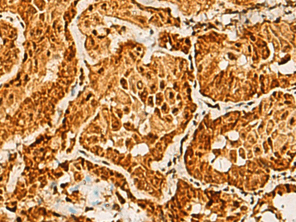Immunohistochemistry of paraffin-embedded Human thyroid cancer tissue using SAP30BP Polyclonal Antibody at dilution of 1:40(×200)