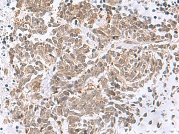 Immunohistochemistry of paraffin-embedded Human lung cancer tissue using RBFOX2 Polyclonal Antibody at dilution of 1:50(×200)