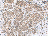 Immunohistochemistry of paraffin-embedded Human lung cancer tissue using RBFOX2 Polyclonal Antibody at dilution of 1:50(×200)